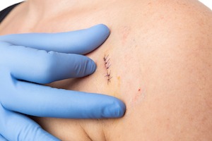 surgical-skin-cancer-removal