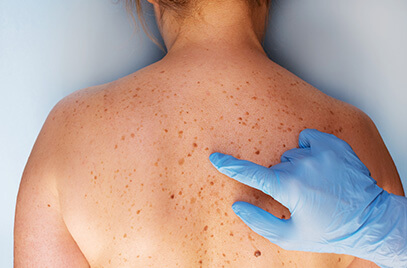skin-cancer-diagnosis